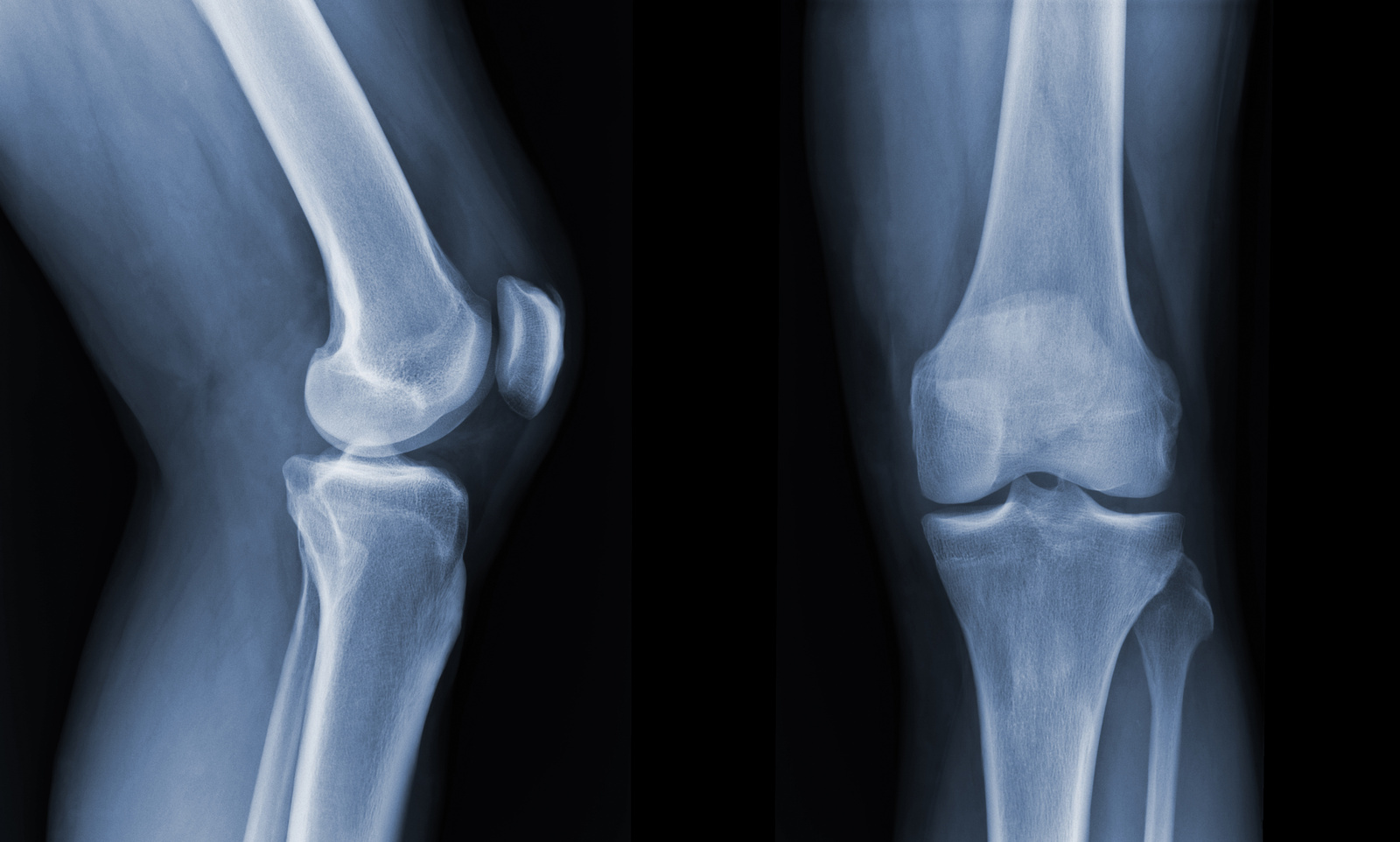  Knee X-Ray Radiograph Showing State of Injury