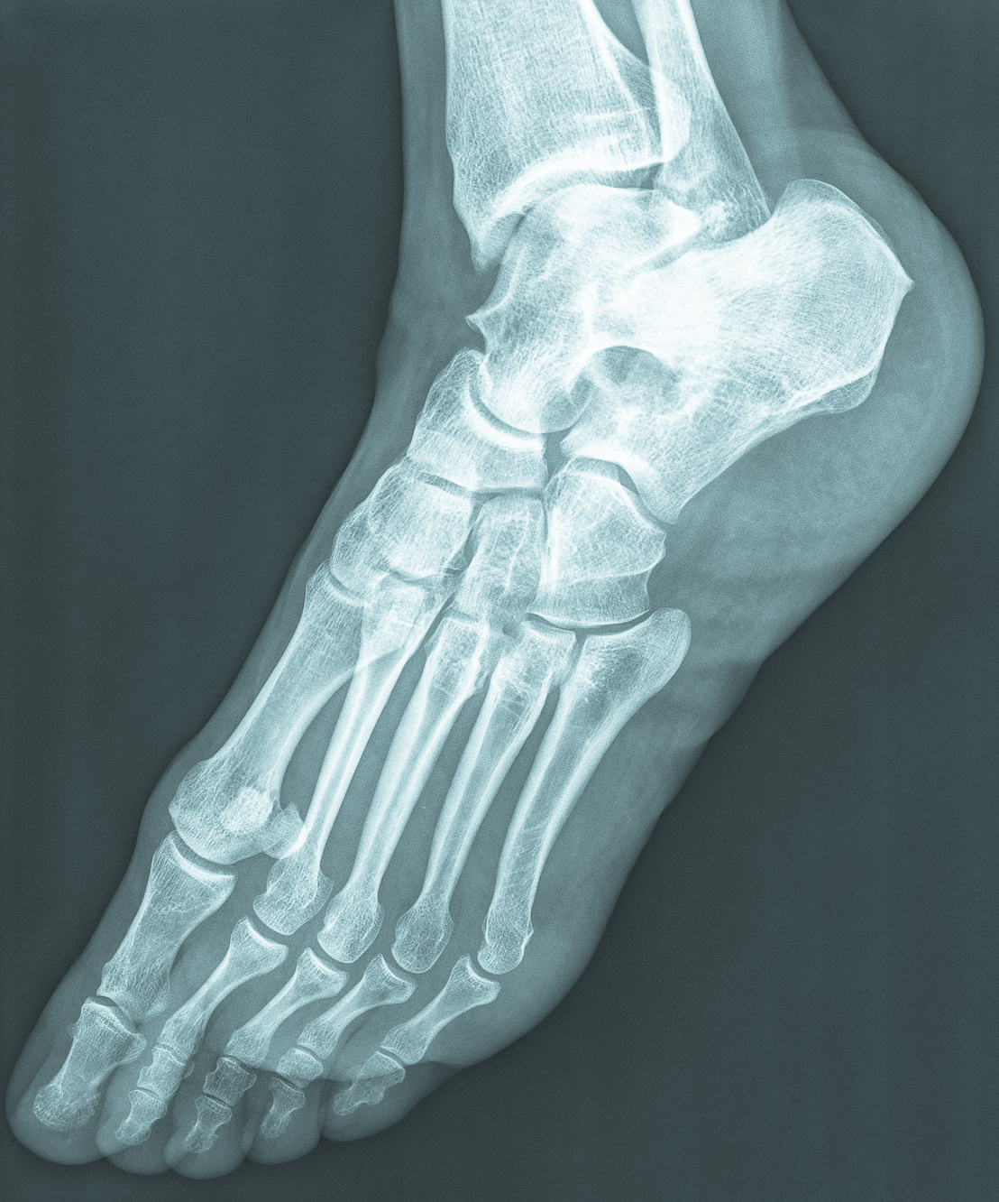 Female Feet Xray Radiograph
